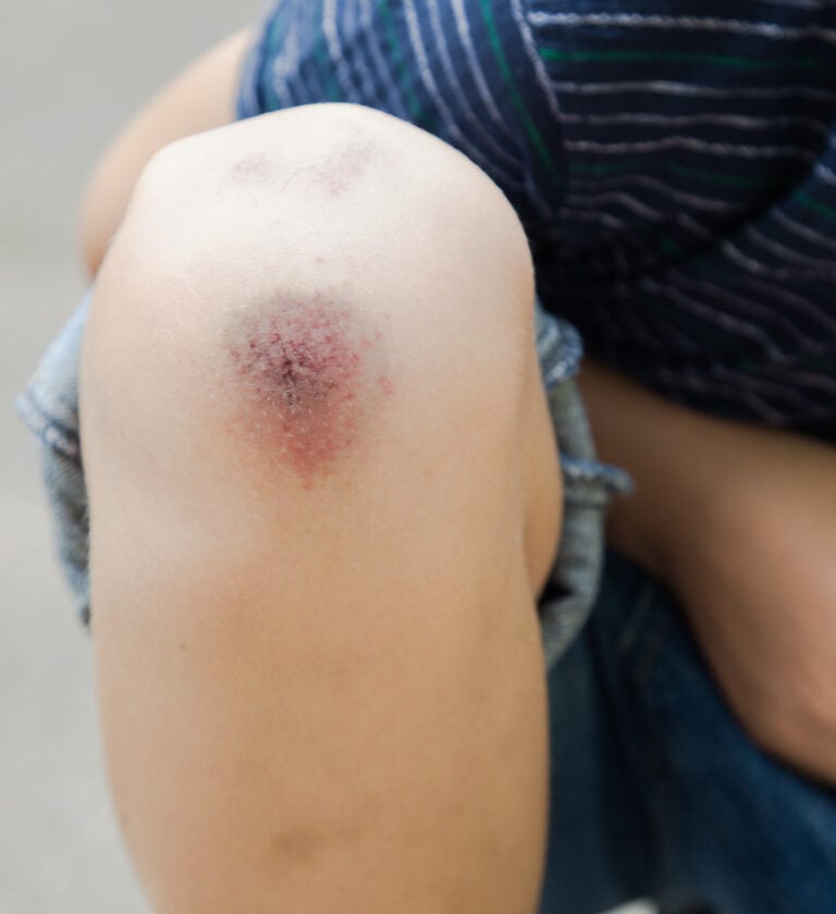 The Most Effective Herbal Remedies for Bruises