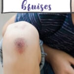 herbal remedies for bruising